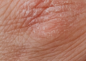 Pityriasis Rosea behandelen schilfering huidgriep Pityriasis Rosea behandelen schilfering huidgriep