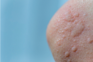 urticaria en warmte urticaria (1)