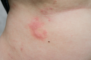 urticaria en warmte urticaria