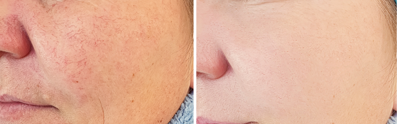 Rosacea gezicht en rosacea behandeling