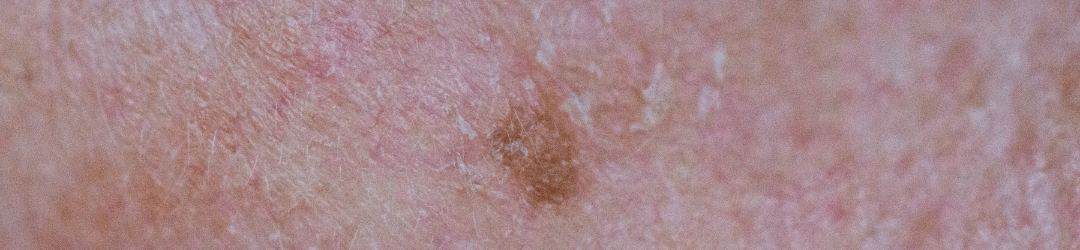 zonneschade behandelen met stikstof